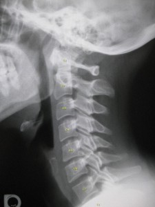 lateralCervical